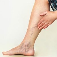 varice pelvienne symptômes venele varicoase asupra tratamentului efectiv al picioarelor