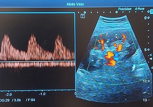 Echo doppler de l'artère rénale à Avignon