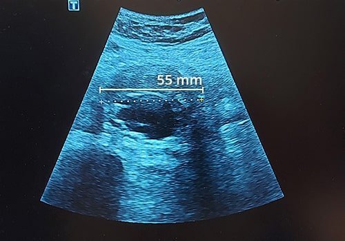 Echographie doppler de l’aorte abdominale à Avignon