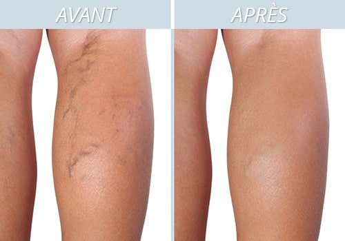 Traitement sclérose des varices avant après à Avignon